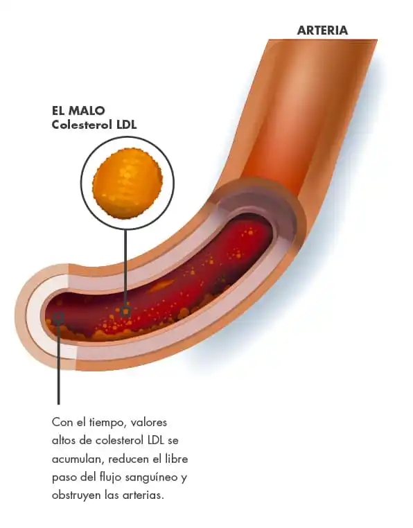 Autor: duduromeroa@. Gráfico a color. Ilustración de arterias con daño a causa de colesterol.