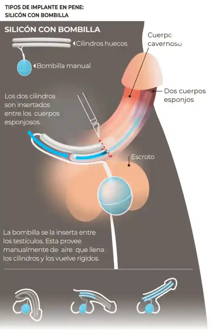 Autor: duduromeroa@. Gráfico a color. Infografía. Implantes masculinos para impotencia sexual. Eduardo J. Romero Andrade. Guayaquil, Ecuador.